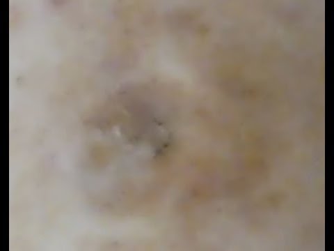 Another 2 alien abductions to space again but not same aliens and have very deep scoop down to bone