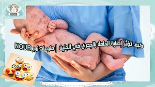 كيف تؤثر إصابة الحامل بالجدري في الجنين