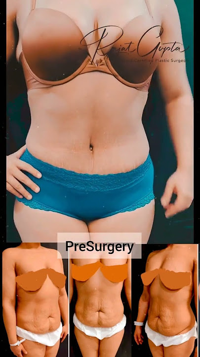 Breast Reduction Surgery Procedure & Postoperative Care - Dr. Rajat Gupta