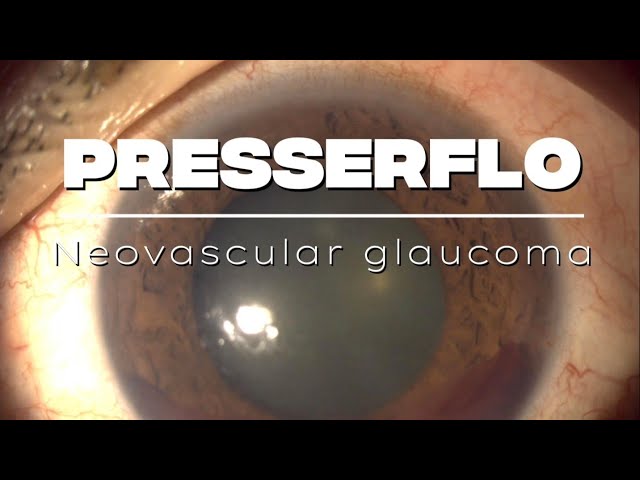 Presserflo in Neovascular #glaucoma