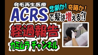 ACRSで髪は生えるか！経過報告(ToT)/~ #acrs #薄毛 #再生医療