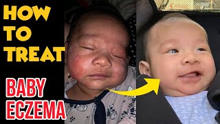 How to treat BABY ECZEMA 100% Effective and Organic!