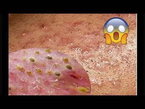 Cystic Acne, Pimples And Blackheads Extraction Acne Treatment On Face!!! - Part 