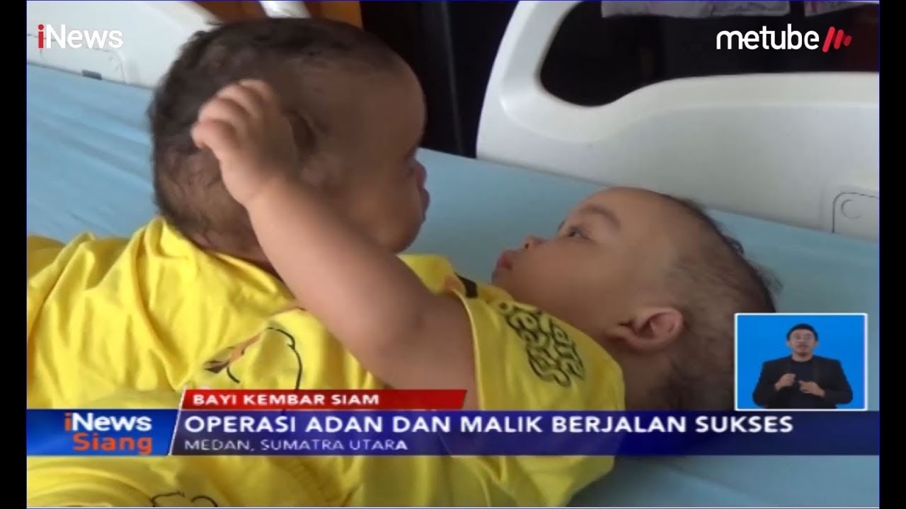 Beginilah Kondisi Kesehatan Bayi Kembar Siam Adam & Malik usai Operasi Pemisahan - iNews Siang 14/08
