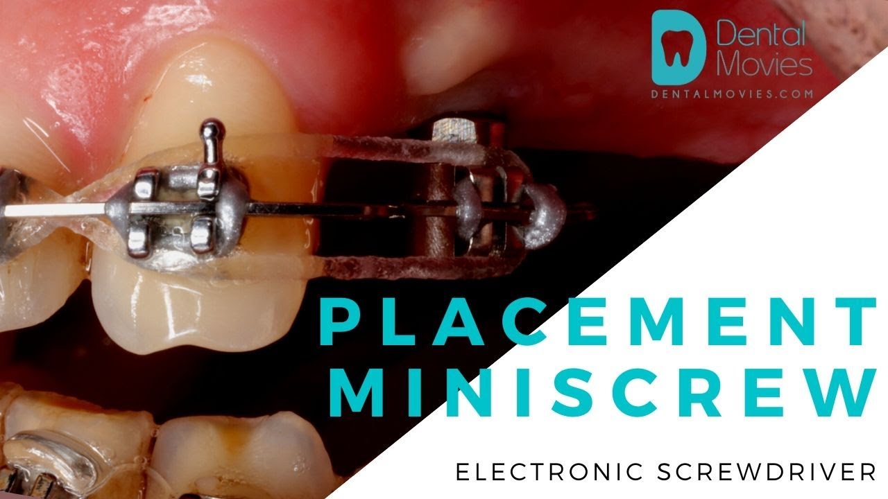 Placement of the miniscrew from PSM with electronic screwdriver. YouTube
