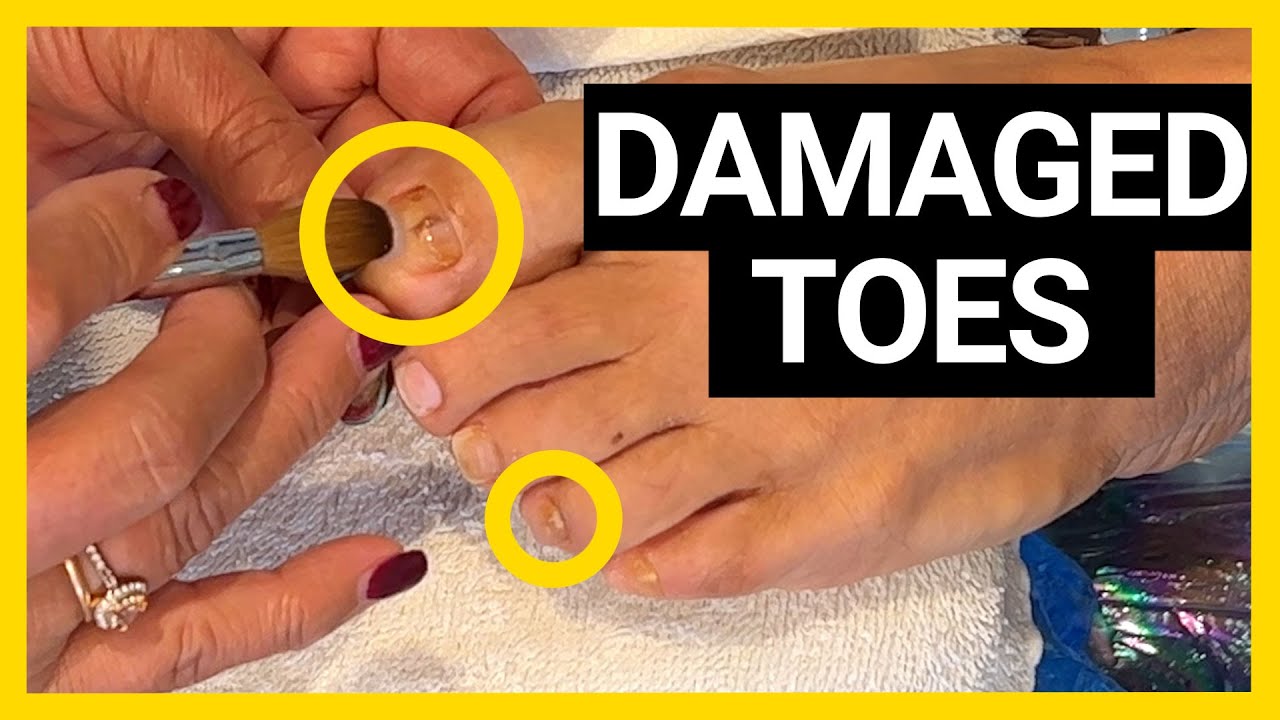 Damaged Toe Nails Fixed with Acrylic Nina's Nails YouTube