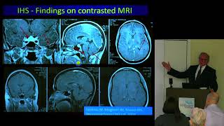 Headaches in the Chiari and EDS Population    Fraser C  Henderson Sr , MD