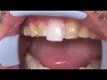 Houston Cosmetic Dentist...Step by step procedure for Porcelain Veneers...Conservative preps!