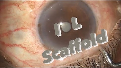 #35 IOL Scaffold in a Mat Cat  (Topical Phaco)