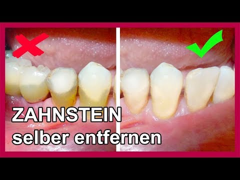 Zahnbelag Zahnstein Selber Entfernen Mit Diesen Hausmittel So Gehts Youtube
