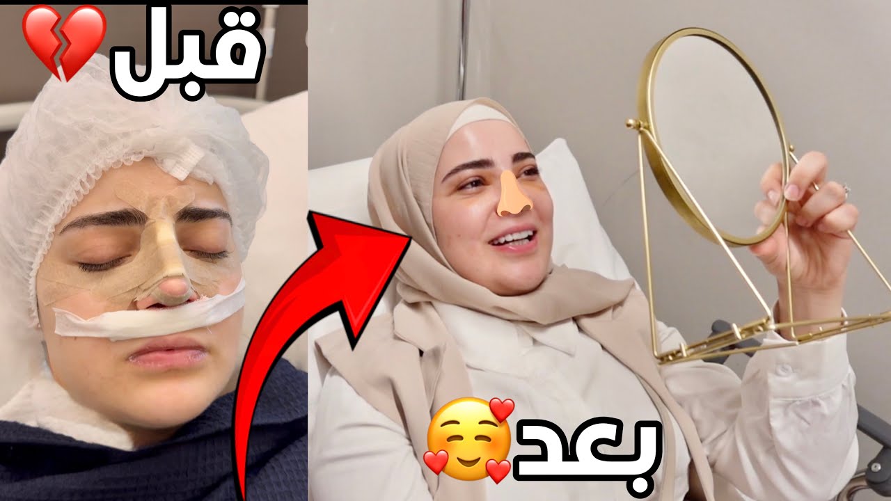 سوينا عملية تجميل الانف بافضل عيادة عربية في تركيا Hospital xp