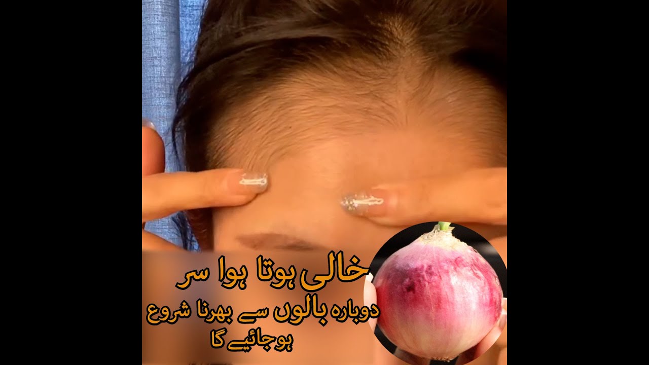 Fastest hair regrowth serum | سامنے سے خالی ہوتا ہوا سر دوبارہ بالوں سے