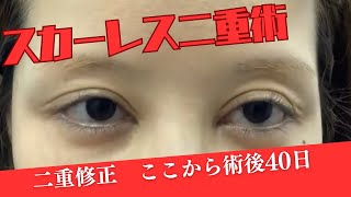スカーレス二重修正　４０日