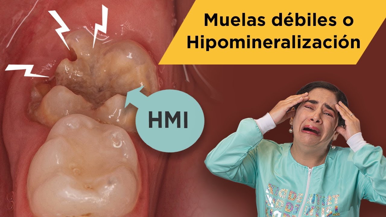 Muelas débiles o Hipomineralización 