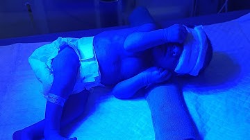 New born baby jaundice treatment on phototherapy lights🚼👨‍⚕️🏥