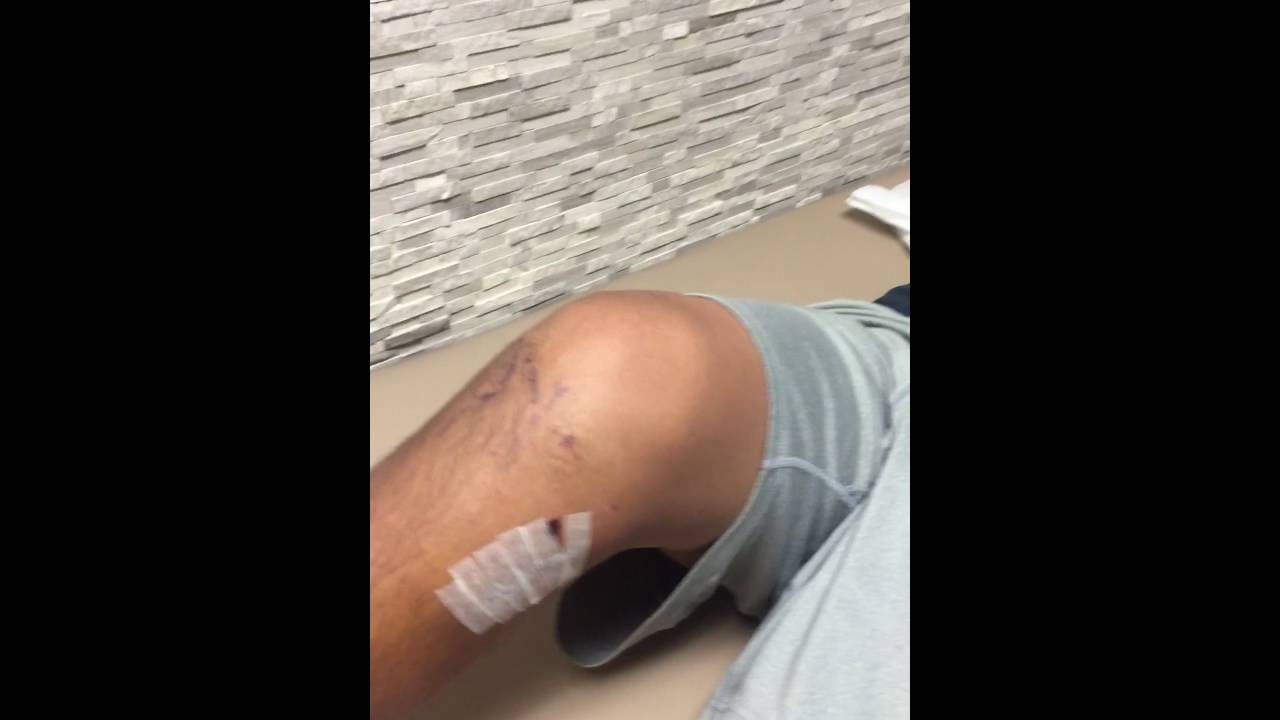 Testimonial R "BMC Stem Cell" ACL and Med Meniscus 8 days postop
