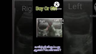 பறககபவத ஆண?பணண?Wingz Of Womenboy Or Girlbaby Gender Predictiongirl Baby Symptoms