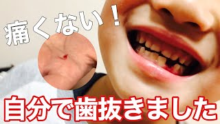 自分で歯抜きました。ぐらぐらの歯をどうやって抜いた？【パート２】