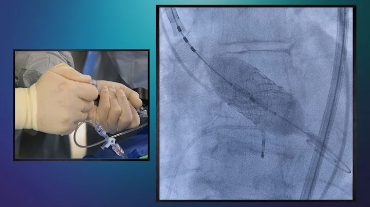 Transcatheter Aortic Valve Replacement (TAVR) – Essentia Health - DayDayNews