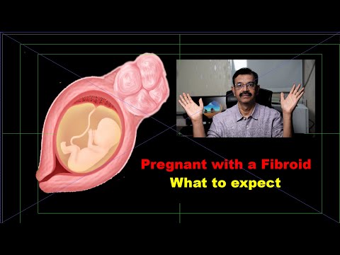 Video: Uterine Fibroids Under Graviditet - Hvorfor Er Det Farlig? Hvordan Behandle?