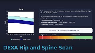 Bodyview Osteoporosis Dexa Scan