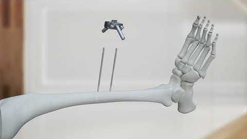 Hoffmann 3 External Fixation System