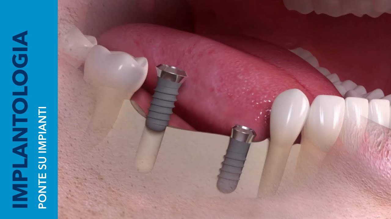 PONTE SU IMPIANTI | In cosa consiste e quali sono i vantaggi