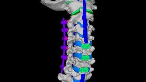 spine with fixation