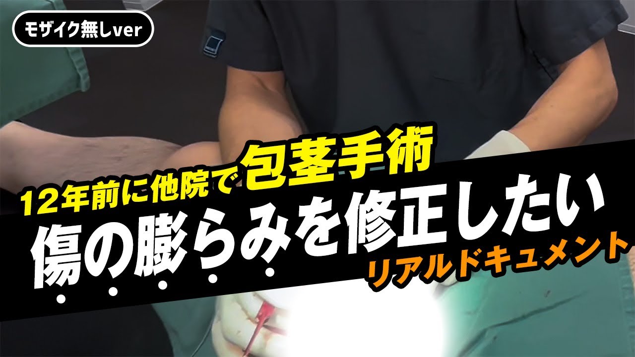 【包茎手術の傷修正】12年前に他院で受けてから傷の膨らみが気になってた…【モザイク無し】 - YouTube