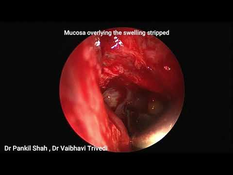 Video: Ethmoid Sinus Anatomija, Funkcijos Ir Diagrama - Kūno žemėlapiai