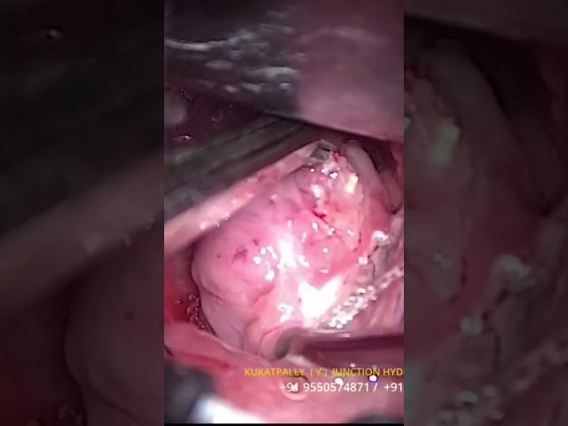 Tonsillectomy (radio frequency)