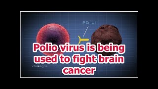 Polio virus is being used to fight brain cancer