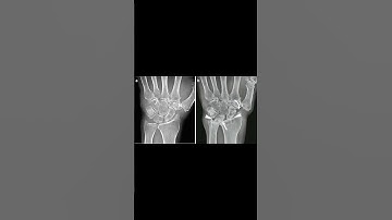 Palmar Midcarpal Ligaments Explained 🖐️#anatomy #wristpain #meded #atc #physiotherapy #orthopedic