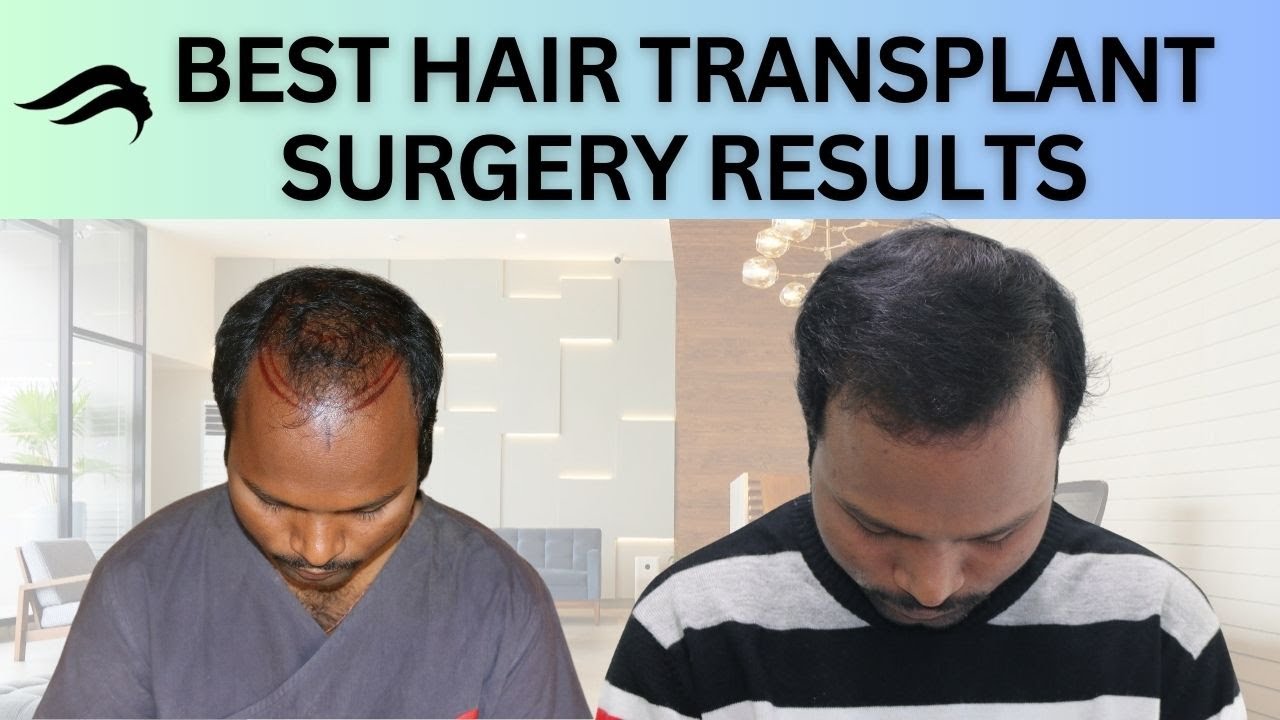 Hair Transplant In Bhubaneswar Best Cost Results of Hair Transplant
