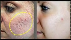 TIPS 3 MENIT HILANG BOPENG/BEKAS JERAWAT MENAHUN DENGAN BAHAN DAPUR - Durasi: 6.32. 