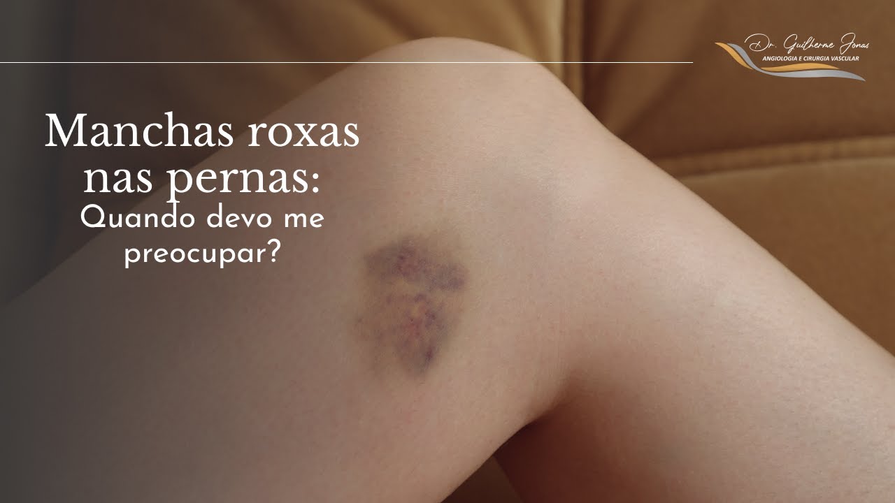 Hematomas Nas Pernas Você Tem Hematomas Frequentes Nas Pernas,