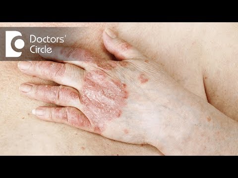 Drugs that worsens  Psoriasis in men - Dr. Tina Ramachander