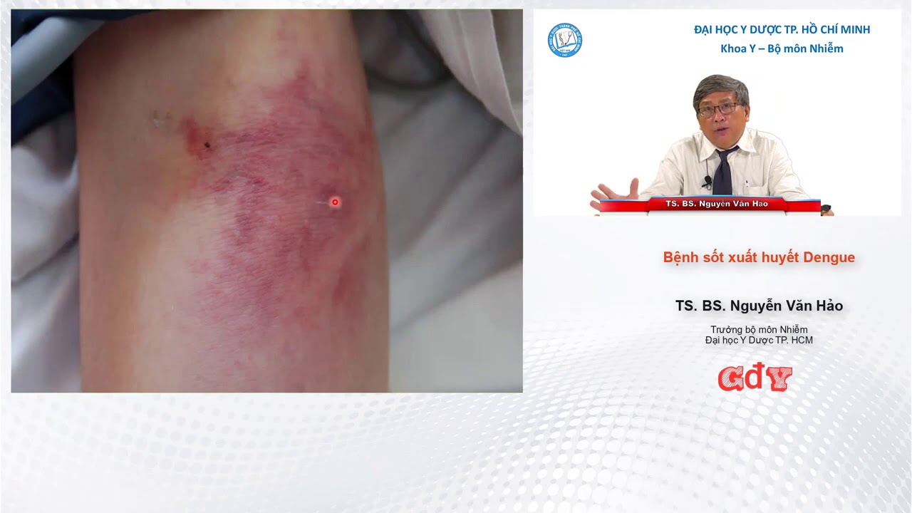 BỆNH SỐT XUẤT HUYẾT DENGUE | TS. BS. Nguyễn Văn Hảo