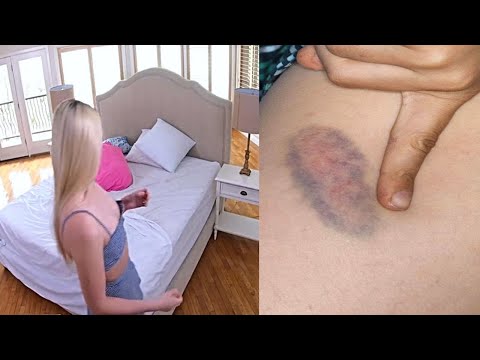 A Father Set Up Camera In Daughter's Room To Find Out Why She Wakes Up With Bruises Every Morning