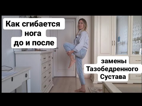 5 лет после замены Тазобедренного Сустава. Как сгибается нога до и после операции