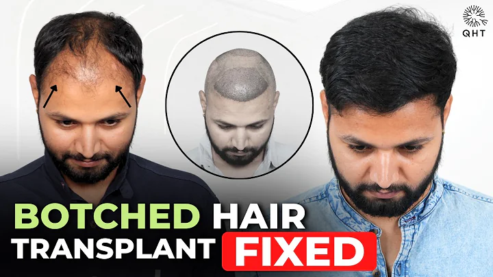 Failed hair transplant | Botched Hair Transplant | Failed Hair Transplant Results | QHT Clinic #qht