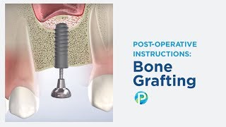 Post-Op Instructions: Bone Grafting in Roseville CA | Placer Oral & Dental Implant Surgery