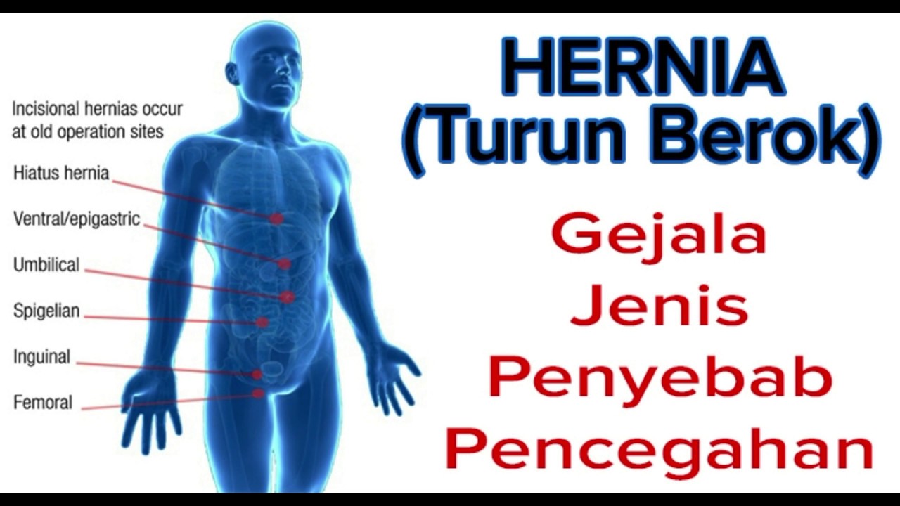 Cara Mengatasi Hernia Tanpa Operasi dgn Konsumsi Herbal Hernia
