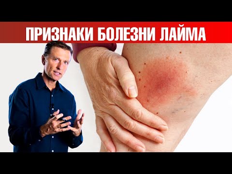 Первые симптомы болезни Лайма (боррелиоз) 👉 что делать?