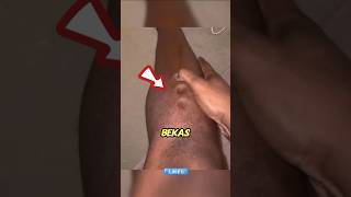 Banyak Orang Tidak Sadar, Cekungan di Kaki Ini Bisa Jadi Sinyal Bahaya! #shorts