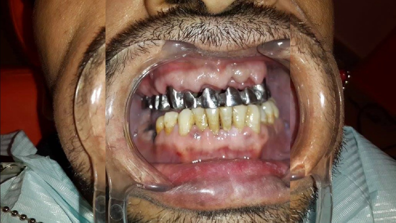 زراعة فورية للفك العلوي وتبيض للسفلي Youtube