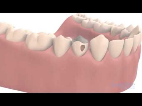 Vidéo: L'allongement de la couronne est-il douloureux ?