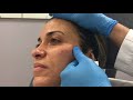 Face rejuvenation using Restylane Lyft, Restylane Defyne and Botox/Dysport by Dr. Patel