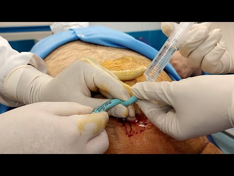 Suprapubic Catheter Placement - Placing a catheter into the bladder through the abdomen