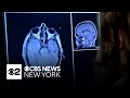Blood test may soon be able to detect and stage Alzheimer's Disease